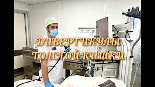 Дивертикулы толстой кишки. Колоноскопия