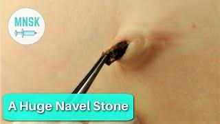 A Huge Navel Stone - Omphalolith by Miss NiceSkin #omphalolith #navelstone #blackheads