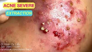 Mụn nhọt ẩn vùng mặt siêu nhiều, siêu thâm|Squeeze big pimples, hidden acnes full Dr Hoan 0985773391