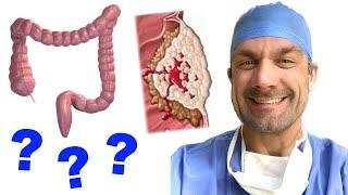 Colorectal Cancer Explained - What You Need to Know