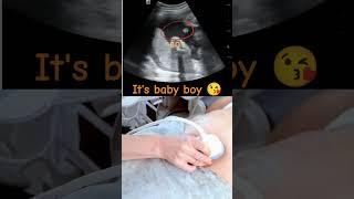 Ultrasound showing boy baby !!!