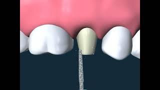 Dental Video for Tooth Facing Gold Crown - The Tooth