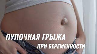 Пупочная грыжа при беременности #doctorberezovska #olenaberezovska #беременность