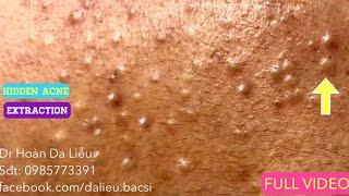 Mụn ẩn đầy mặt|Dermatologist,pimples,blackhead,anti acne,hidden acne removal Dr Hoan 0985773391 full