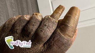 TWO REALLY OVERGROWN NAILS