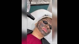 Hollywood peel,doll peel and carbon peel all are same .This procedure is done by Qswitch  laser .
