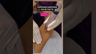 Reasons for Underarm Darkening | Aiconic Health