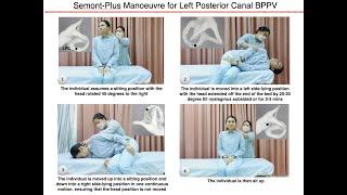 Semont-Plus Manoeuvre for Left Posterior Canal BPPV