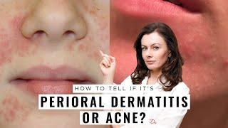 Perioral Dermatitis or Acne? How to Tell the Difference | Dr Sam Bunting