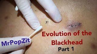 Evolution of the blackhead part 1. The rare trident blackhead! Triple barrel extraction.