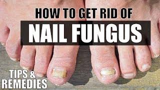 How To Treat Toenail & Nail Fungus | Tips & Remedies by Guru Mann