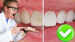 Dentist Reveals The BEST Teeth Whitening Results with Research! Overnight Carbamide Peroxide Gel Kit