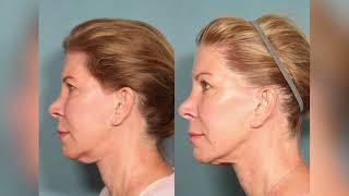 SofWave Non Invasive Skin Tightening Ultrasound Treatment