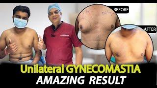 Unilateral Gynecomastia Surgery Results | Dr. Deepesh Goyal | Rejuvena Cosmo Care Jaipur |