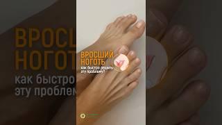 ВРОСШИЙ НОГОТЬ. ЧТО ДЕЛАТЬ С ВРОСШИМ НОГТЕМ? ЧЕМ ОН ОПАСЕН? #доктор