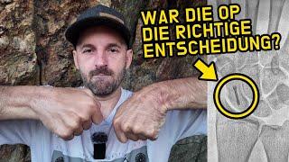 War die OP die richtige Entscheidung für meine Verletzung? | Scaphoidfraktur Heilungsverlauf