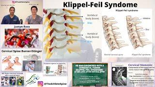 Cervical Stenosis and Congenital Fusion (Klippel-Feil) in NFL Wide Receiver, Justyn Ross!