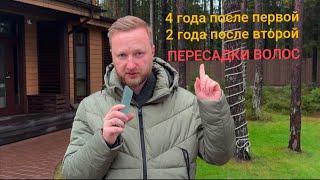 4 года после первой и 2 года после второй пересадки волос.