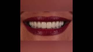 Laminate Veneers - Dr. Serhan Aktan