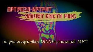 БОЛЬ В КИСТИ руки при АРТРОЗО АРТРИТЕ лучезапястного сустава на РАСШИФРОВКЕ МРТ кисти второе мнение