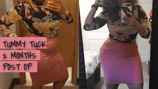 Tummy Tuck 2 Month Update | Before/After pictures