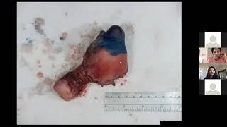 A rare cornual ectopic partial molar pregnancy - Dr. Joshua Warner