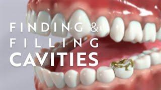 The process of finding and filling dental cavities