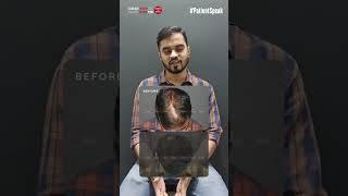 Stop Hair Loss in Its Tracks with PRP Therapy – See the Difference! | Testimonial | HairMD, Pune