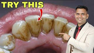 1 Simple Home Remedy For Yellow Teeth, Dental Plaque, Cavities