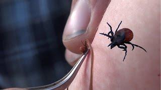 Если укусил клещ как вытащить клеща пинцетом Клещи лесные How To Remove A Tick