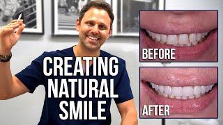 Using Porcelain Veneers To Create a Natural Smile - Dental Science