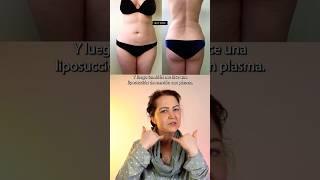 Canadian Patient’s BBL & Lipo 360 Testimonial with Dr. Ghurani 