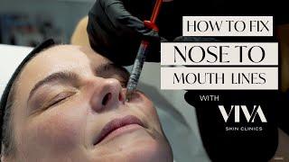 TREATING NOSE TO MOUTH LINES | DERMAL FILLERS