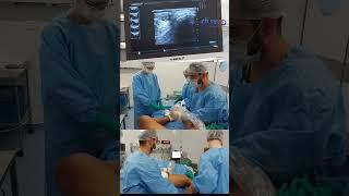 Cirurgia de Varizes a LASER - Equipe Fluxo de Cirurgia Vascular #shorts