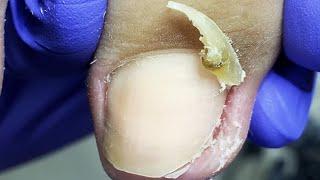 Extra long nails are rare, professional pedicure【Doctor Liu Pedicure】