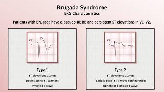 Advanced EKGs - Sudden Cardiac Death (Hypertrophic cardiomyopathy, ARVD, Brugada syndrome, and CPVT)