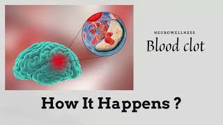 Blood clot, How it happens? NeuroWellness India