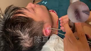 Skillfully extracting thin ear skin ear cleaning asmr ear wax removal