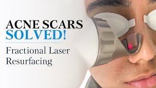 ACNE SCAR REMOVAL - Fractional Laser Resurfacing Treatment | Laser Treatment for Acne Scars