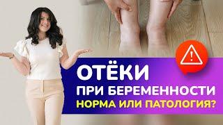 Отеки при беременности: норма или патология? Как бороться с отеками