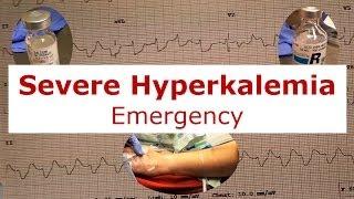 Severe Hyperkalemia Emergency