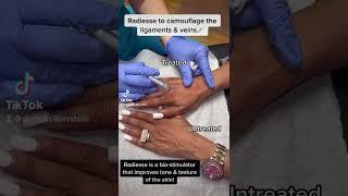 Radiesse Injections For The Hands!