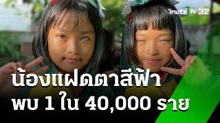 โซเชียลแชร์ความน่ารัก น้องแฝดตาสีฟ้า พบ 1 ใน 40,000 ราย | 5 พ.ย. 67 | ข่าวเย็นไทยรัฐ