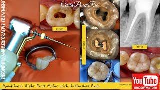 one visit endodontic treatment one curve micro mega xtrabase voco endodontist perawatan saluran akar