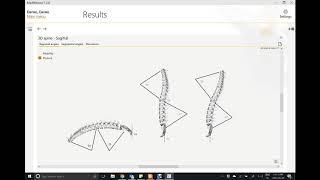 Программа аппарата  Spinal Mouse. Диагностика позвоночника.