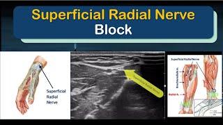 SUPERFICIAL RADIAL NERVE Block - a "How-To" Guide (for Motor-Sparing Wrist Blocks)