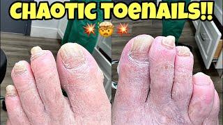 Perfectly Trimmed THICK TOENAILS and CALLUS REMOVAL