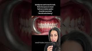 Smile makeover | natural porcelain veneers | porcelain veneers before and after | Dr. Yazdan