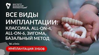 Виды имплантации зубов: Классика, All-on-4, All-on-6, Скуловая имплантация, Базальный метод.