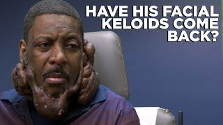 HOW TONY'S FACIAL KELOIDS HEALED